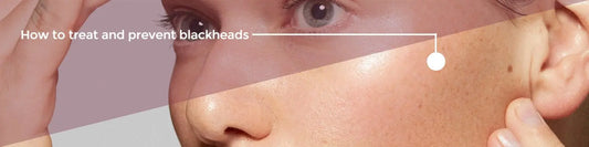 How to treat and prevent blackheads - Heaven Therapy Skincare