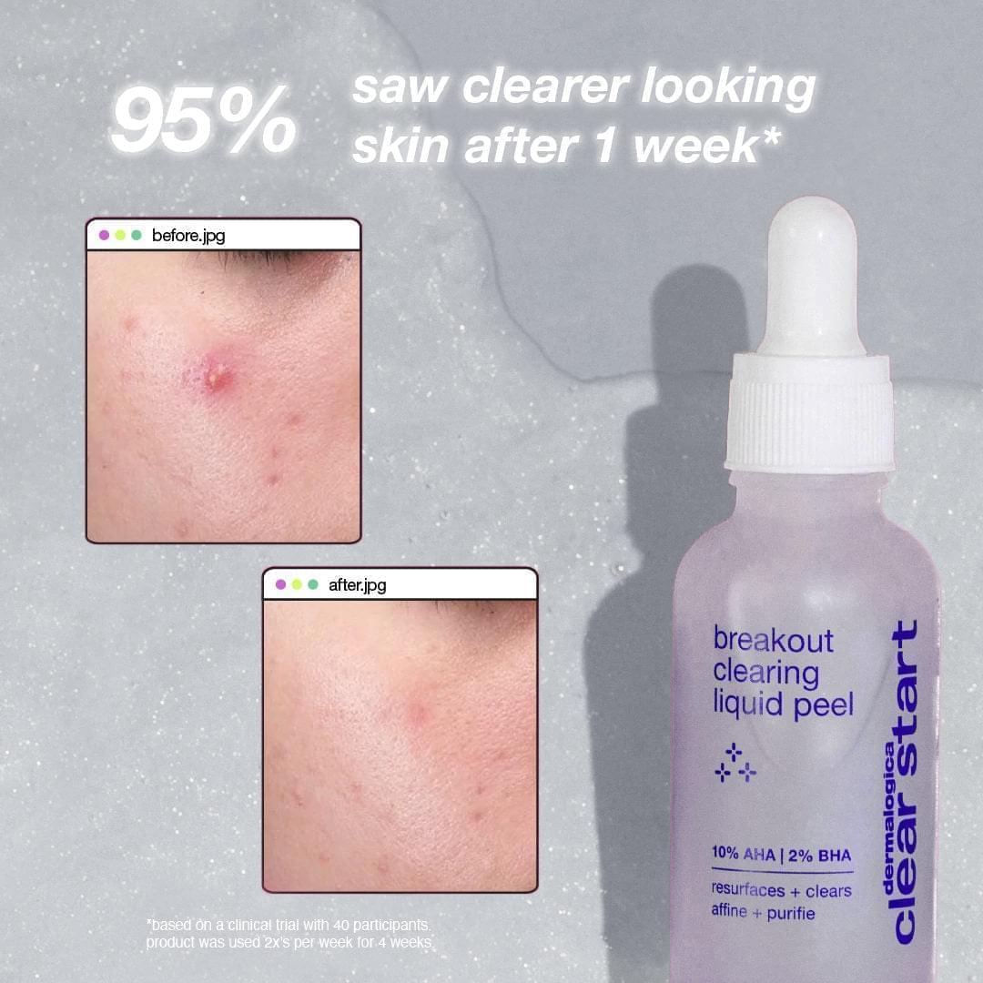 Clear Start Breakout Liquid Peel - Heaven Therapy Skincare (7564625510560)